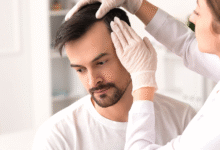 Is Restoring Your Hairline in Dubai the Best Choice for Your Transformation?